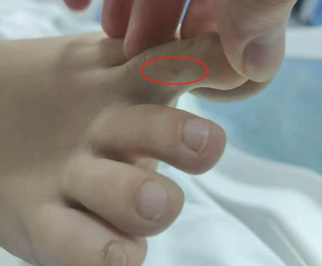 ”死亡记录：曾诊断为不明生物咬伤(神经毒蛇) 等AG旗舰厅“三亚旅游被不明物咬伤身亡27岁女子(图5)